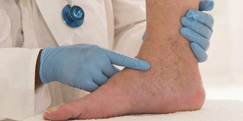 Cheaguri de sânge la nivelul piciorului: Cauze și simptome
