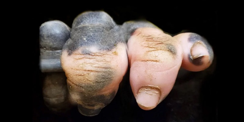 Mâna depigmentată a unei gorile ne arată cât de asemănători suntem