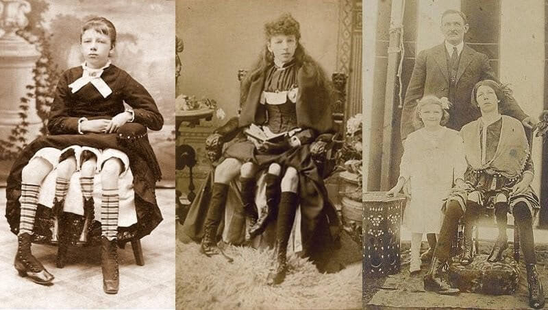 Povestea Josephinei Myrtle Corbin, femeia cu două vagine și 4 picioare care a născut 5 copii