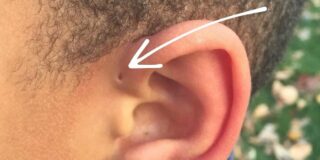 De ce unii oameni au o mică gaură lângă ureche?