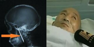 Un bărbat care avea dureri de cap a descoperit că are de 4 ani un cuțit ruginit în craniu